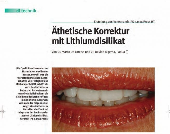Äthetische Korrektur mit Lithiumdisilikat