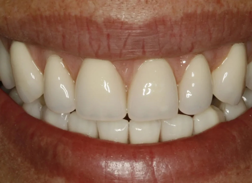 Faccette dentali