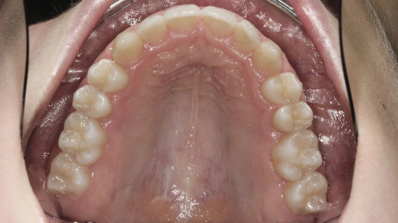 Caso di dentosofia 7 Studio Dentistico De Lorenzi Veronese - studio dentistico a Padova