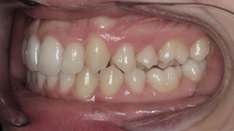 Caso di dentosofia 9 Studio Dentistico De Lorenzi Veronese - studio dentistico a Padova